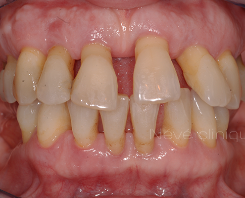 dental implant - Geneva