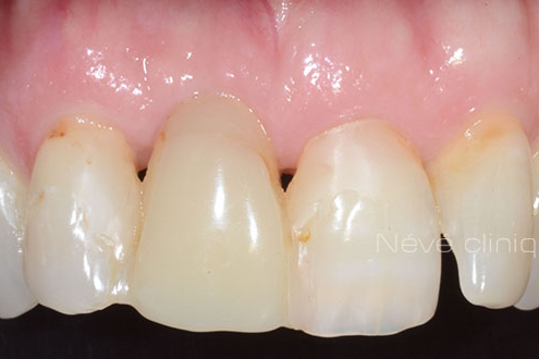 Zirconia implant - Geneva