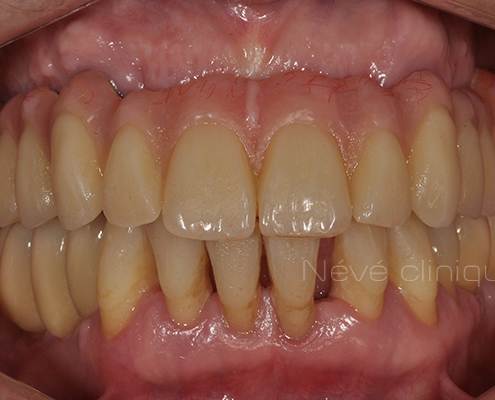 dental implant - Geneva