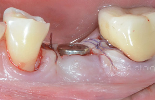 dental implant - Geneva