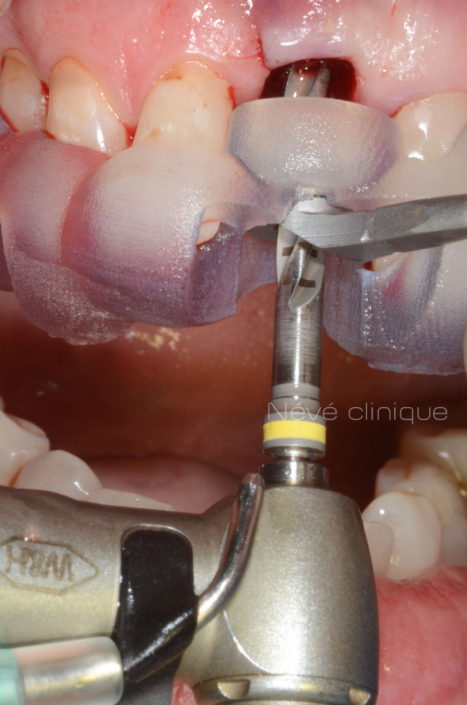 Zirconia implant - Geneva