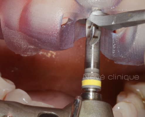 Zirconia implant - Geneva