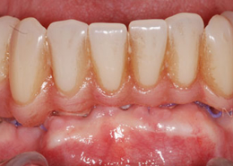 Implants dentaires - Genève