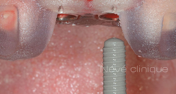 dental implant - Geneva