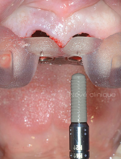 dental implant - Geneva