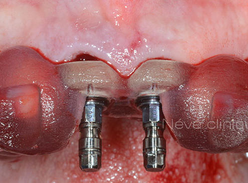 dental implant - Geneva