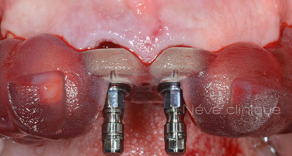 dental implant - Geneva