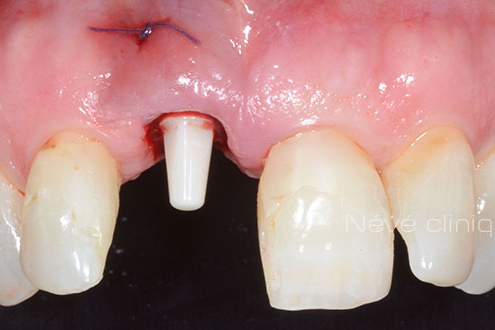 Zirconia implant - Geneva