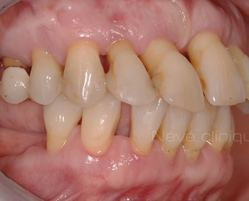 dental implant - Geneva