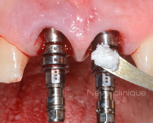 dental implant - Geneva