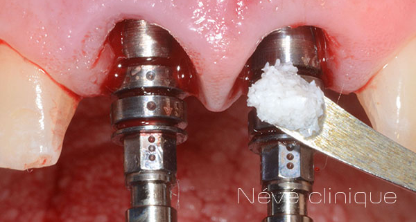 dental implant - Geneva