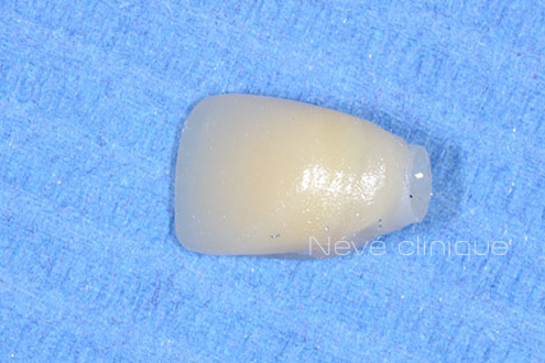 Zirconia implant - Geneva