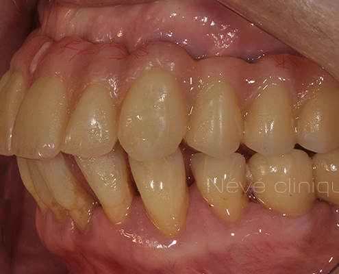 dental implant - Geneva