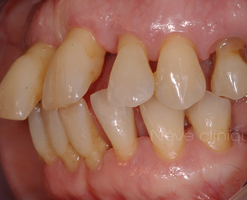 dental implant - Geneva