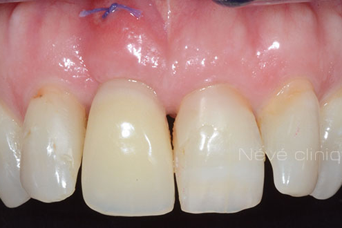 Zirconia implant - Geneva