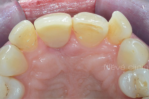 Zirconia implant - Geneva