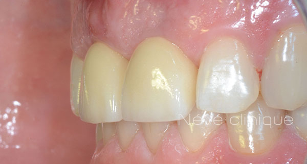 dental implant - Geneva