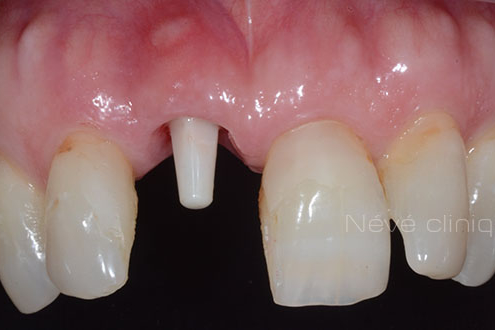 Zirconia implant - Geneva