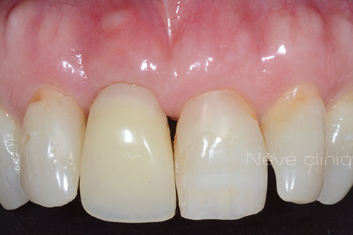 Zirconia implant - Geneva