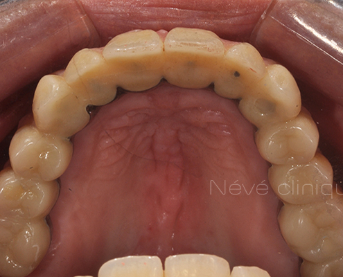 dental implant - Geneva