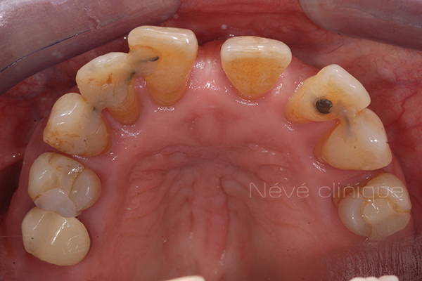 Charge immédiate sur implant dentaire - Des dents provisoires directement