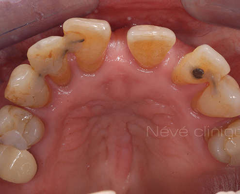 dental implant - Geneva