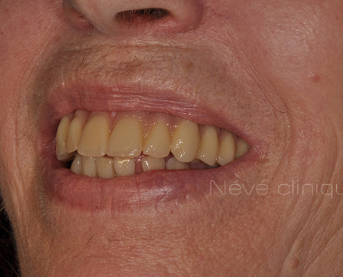 dental implant - Geneva