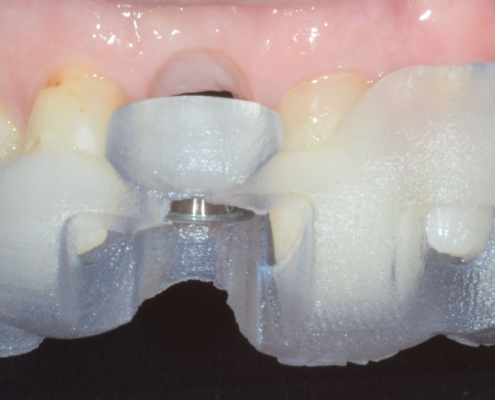 Zirconia implant - Geneva