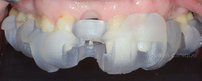 Zirconia implant - Geneva