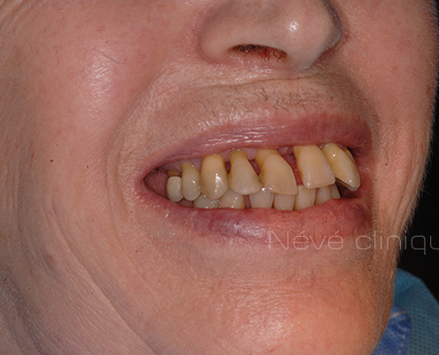 Implants dentaires - Genève