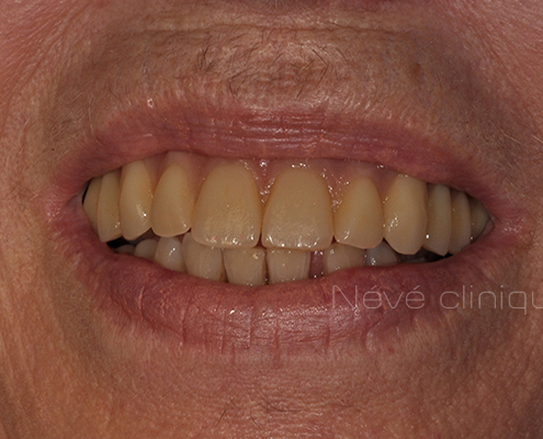 dental implant - Geneva