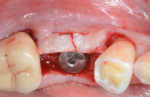 dental implant - Geneva