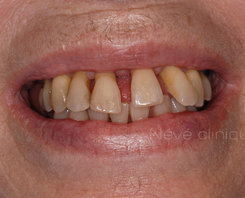 dental implant - Geneva