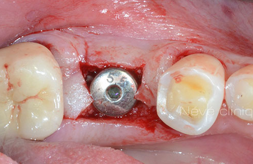 dental implant - Geneva