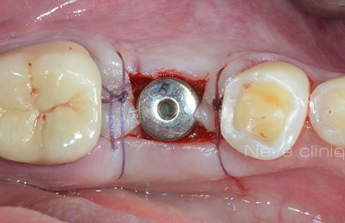 dental implant - Geneva