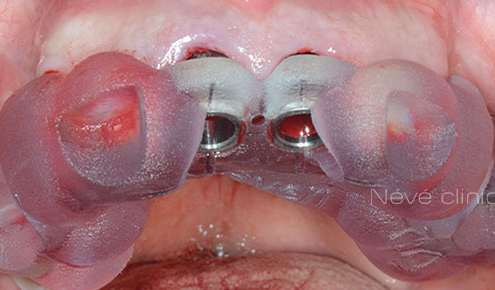 dental implant - Geneva