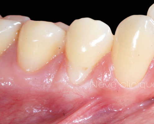 Gingival graft -Geneva