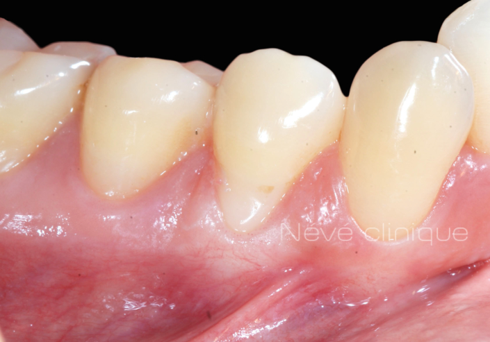 Gingival graft -Geneva