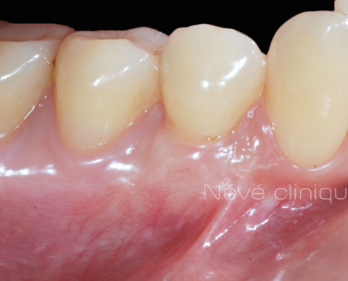 Gingival graft -Geneva