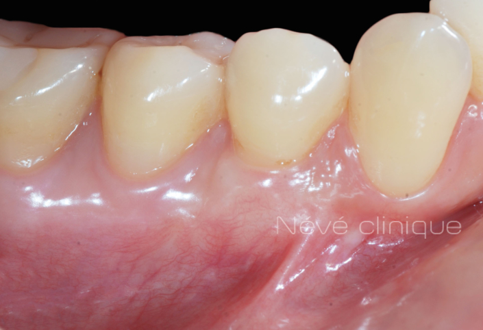 Gingival graft -Geneva