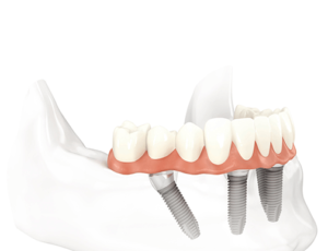 dental implant - Geneva