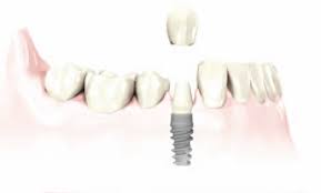 dental implant - Geneva