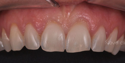 Gingival graft -Geneva