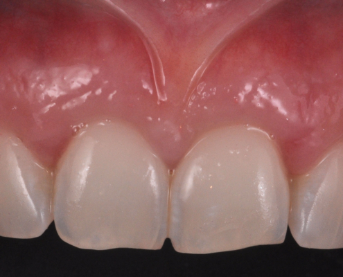 Gingival graft -Geneva