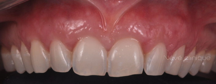 Gingival graft -Geneva