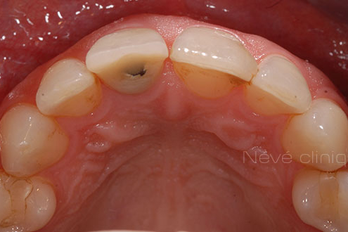 dental implant - Geneva