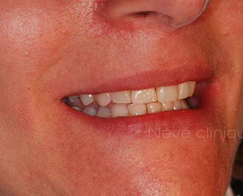 dental implant - Geneva