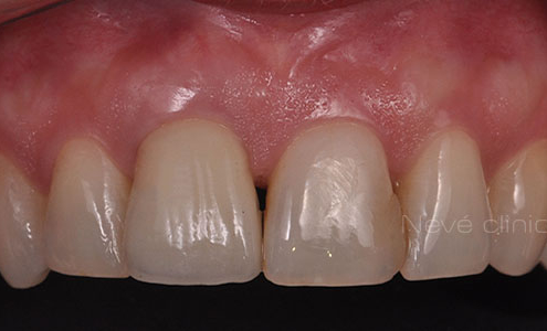 dental implant - Geneva