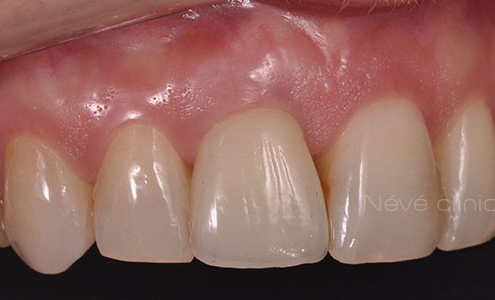 dental implant - Geneva