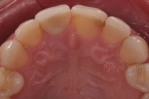 dental implant - Geneva